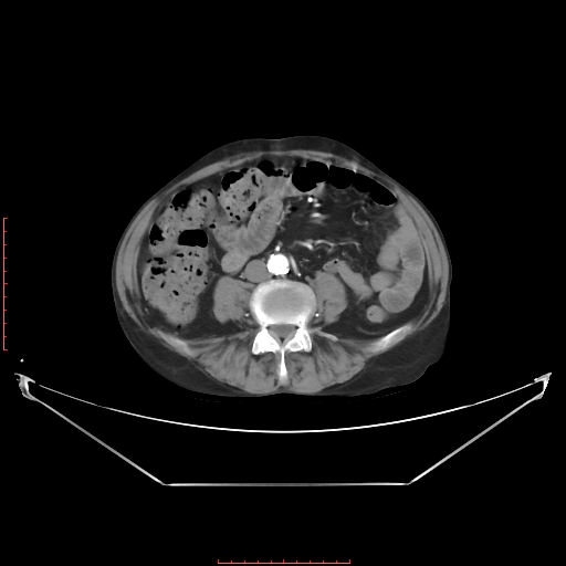 Adrenal hemangioma (Radiopaedia 68923-78668 Axial C+ arterial phase 45).jpg