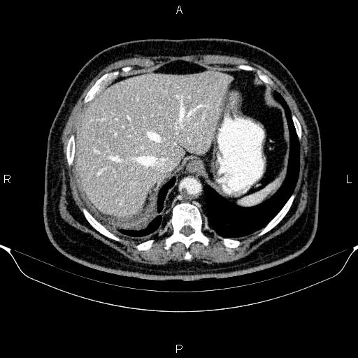 Adrenal hemorrhage (Radiopaedia 62622-70916 Axial C+ portal venous phase 24).jpg