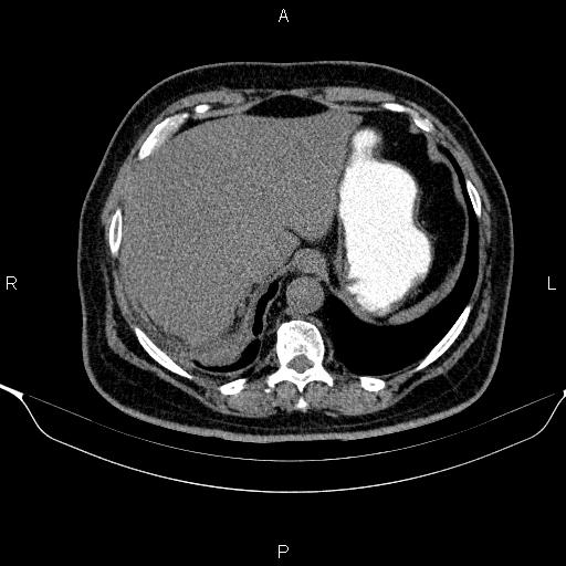 Adrenal hemorrhage (Radiopaedia 62622-70916 Axial non-contrast 26).jpg