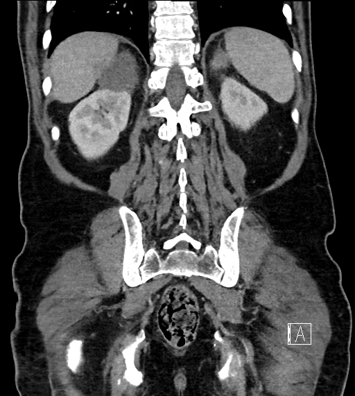 Adrenal lymphoma (Radiopaedia 73730-84529 Coronal C+ portal venous phase 64).jpg