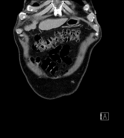 Adrenal lymphoma (Radiopaedia 73730-84529 Coronal C+ portal venous phase 8).jpg