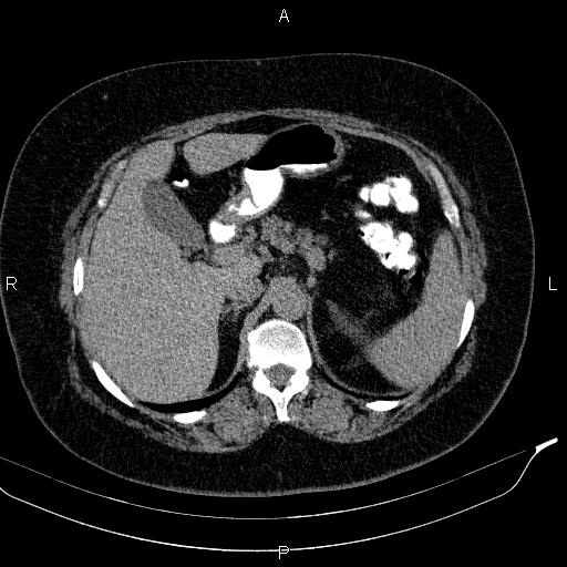 Adrenal myelolipoma (Radiopaedia 84319-99617 Axial With oral contrast 63).jpg