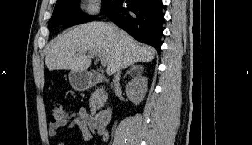 File:Adrenal myelolipoma (Radiopaedia 84321-99619 Sagittal non-contrast 42).jpg
