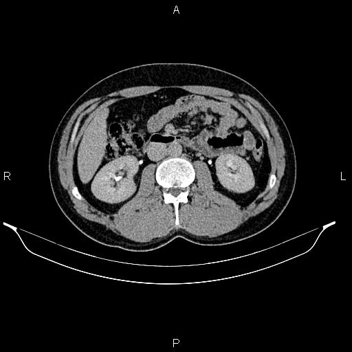 Adrenal myelolipoma (Radiopaedia 87794-104246 Axial renal excretory phase 46).jpg