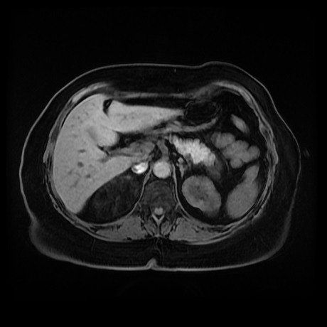 Adrenal myelolipoma - MRI (Radiopaedia 83249-97646 Axial T1 fat sat 27).jpg