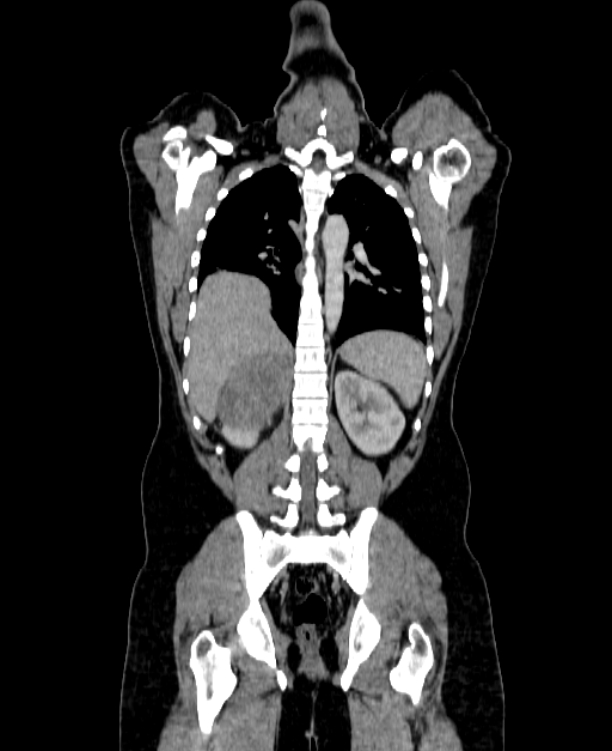 Adrenocortical carcinoma (Radiopaedia 80134-93438 Coronal C+ portal venous phase 116).jpg