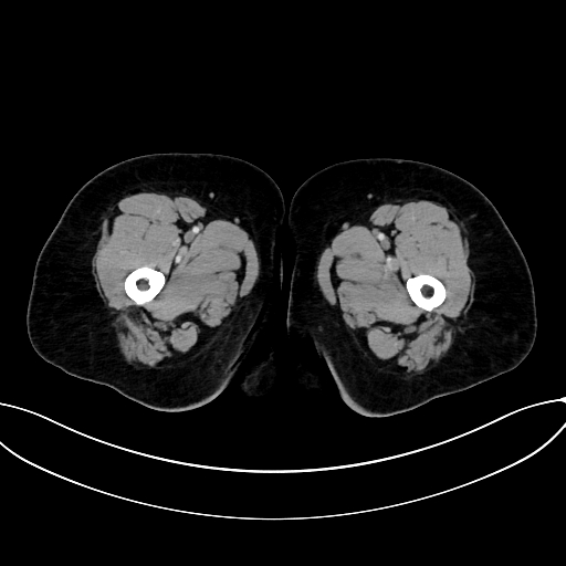 Adrenocortical carcinoma (Radiopaedia 87281-103569 Axial C+ portal venous phase 101).jpg
