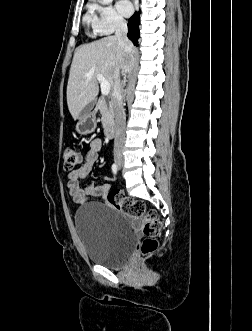 Adrenocortical carcinoma (Radiopaedia 87281-103569 Sagittal C+ portal venous phase 135).jpg