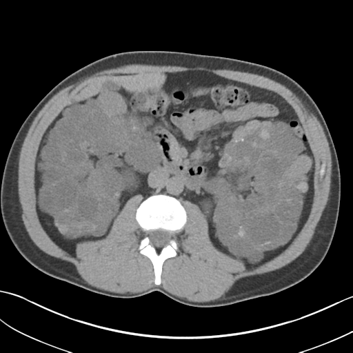 File:Adult polycystic kidney disease (Radiopaedia 47866-52626 Axial non-contrast 36).png