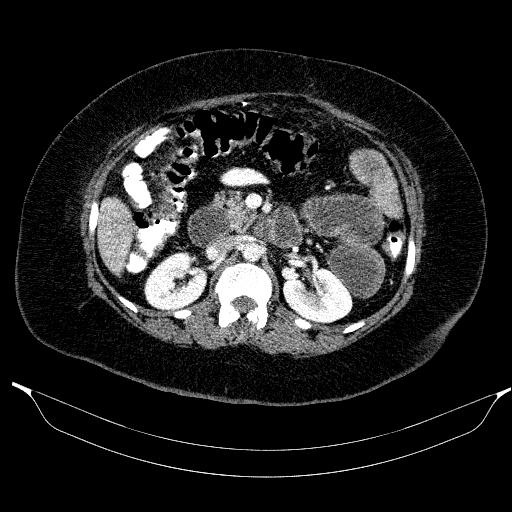 Afferent loop syndrome - secondary to incarcerated trocar site hernia (Radiopaedia 82959-97305 Axial C+ portal venous phase 94).jpg
