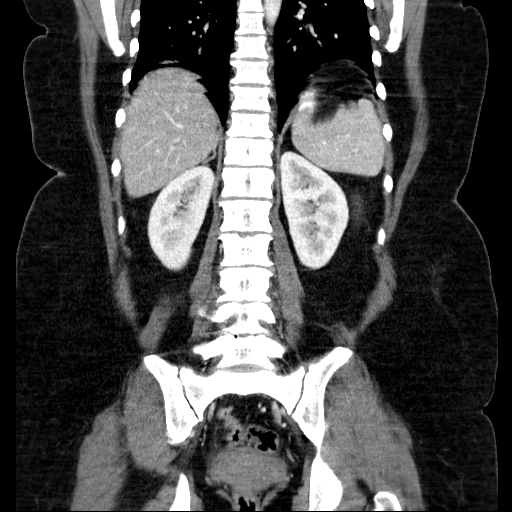 File:Afferent loop syndrome - secondary to incarcerated trocar site hernia (Radiopaedia 82959-97305 Coronal C+ portal venous phase 105).jpg