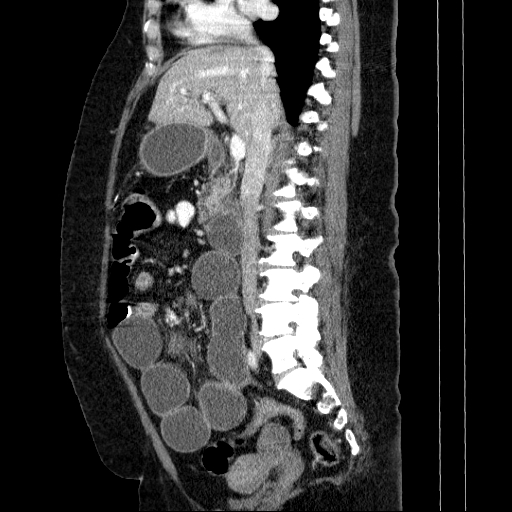 File:Afferent loop syndrome - secondary to incarcerated trocar site hernia (Radiopaedia 82959-97305 Sagittal C+ portal venous phase 88).jpg