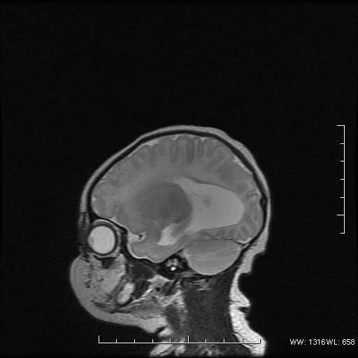 File:Agenesis of the corpus callosum (Radiopaedia 16190-16010 Sagittal T2 16).png