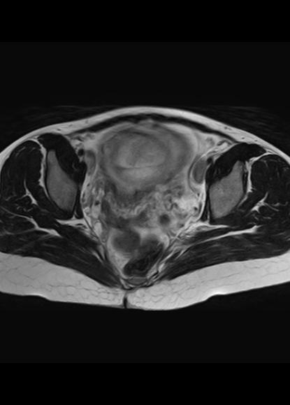 File:Aggressive angiomyxoma of the pelvis and perineum (Radiopaedia 59162-66479 Axial T2 12).jpg