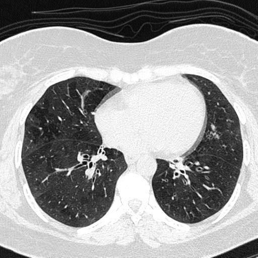 File:Air trapping in small airway disease (Radiopaedia 61685-69694 Axial lung window 105).jpg