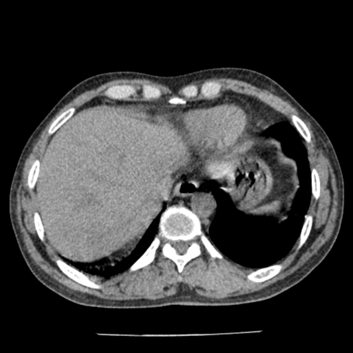 Airway foreign body in adult (Radiopaedia 85907-101779 Axial liver window 161).jpg