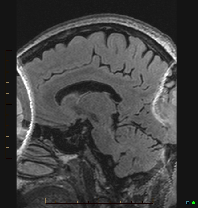 Aliasing artifact causing a spurious cerebellar lesion (Radiopaedia 48783-53810 Sagittal FLAIR 28).jpg