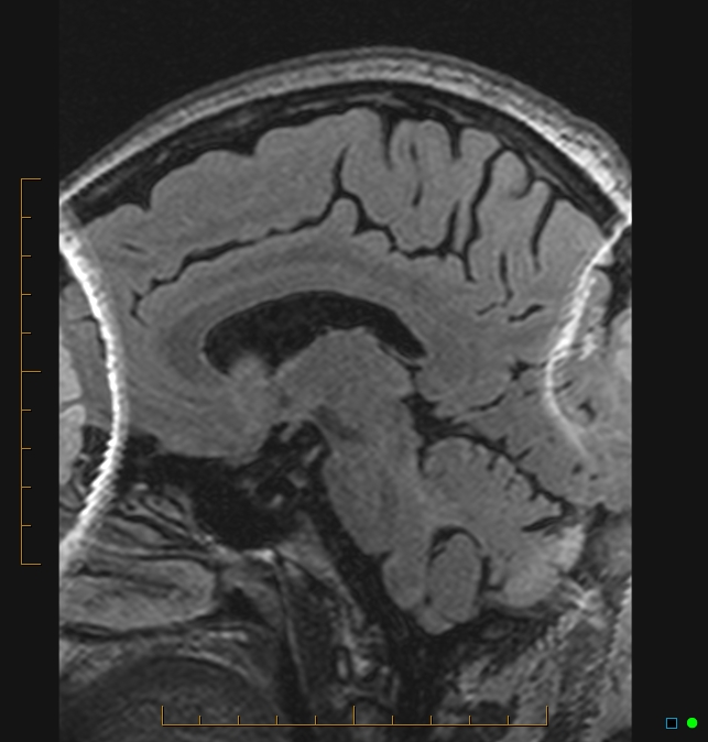 Aliasing artifact causing a spurious cerebellar lesion (Radiopaedia 48783-53810 Sagittal FLAIR 32).jpg