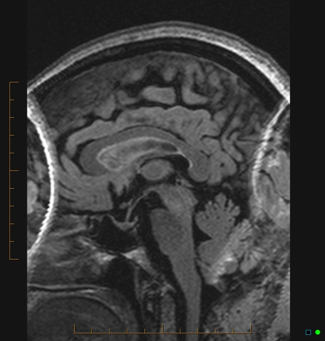 Aliasing artifact causing a spurious cerebellar lesion (Radiopaedia 48783-53810 Sagittal FLAIR 46).jpg