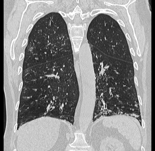 Alpha-1-antitrypsin deficiency (Radiopaedia 72058-82557 Coronal lung window 66).jpg