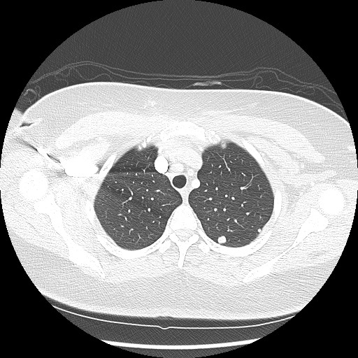 Alveolar soft part sarcoma - right leg (Radiopaedia 59432-67091 Axial lung window 24).jpg