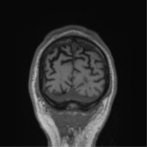 Alzheimer's disease- with Gerstmann syndrome and dressing apraxia (Radiopaedia 54882-61150 Coronal T1 10).png