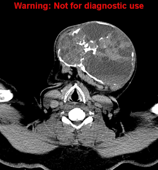 File:Ameloblastoma (Radiopaedia 33126-34164 B 25).jpg
