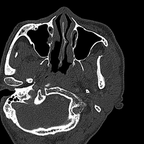 Ameloblastoma (Radiopaedia 51921-57766 Axial bone window 134).jpg