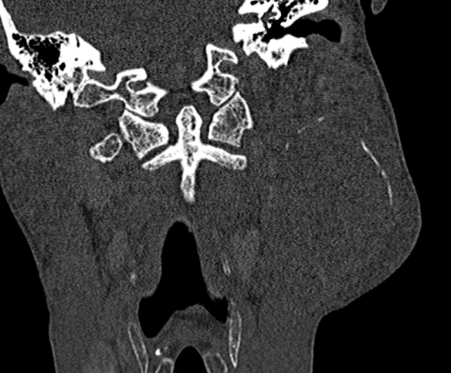 Ameloblastoma (Radiopaedia 51921-57766 Coronal bone window 211).jpg