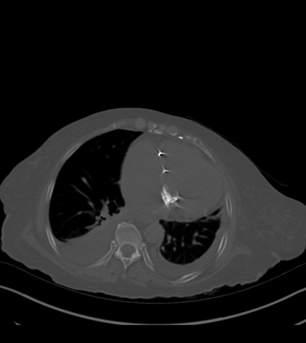 Amiodarone deposition in the liver (Radiopaedia 77587-89780 Axial bone window 56).jpg