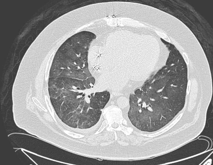 Amiodarone lung (Radiopaedia 62514-70769 Axial lung window 57).jpg