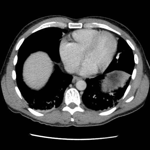 Amoebic liver abscesses (Radiopaedia 55536-62009 A 8).jpg