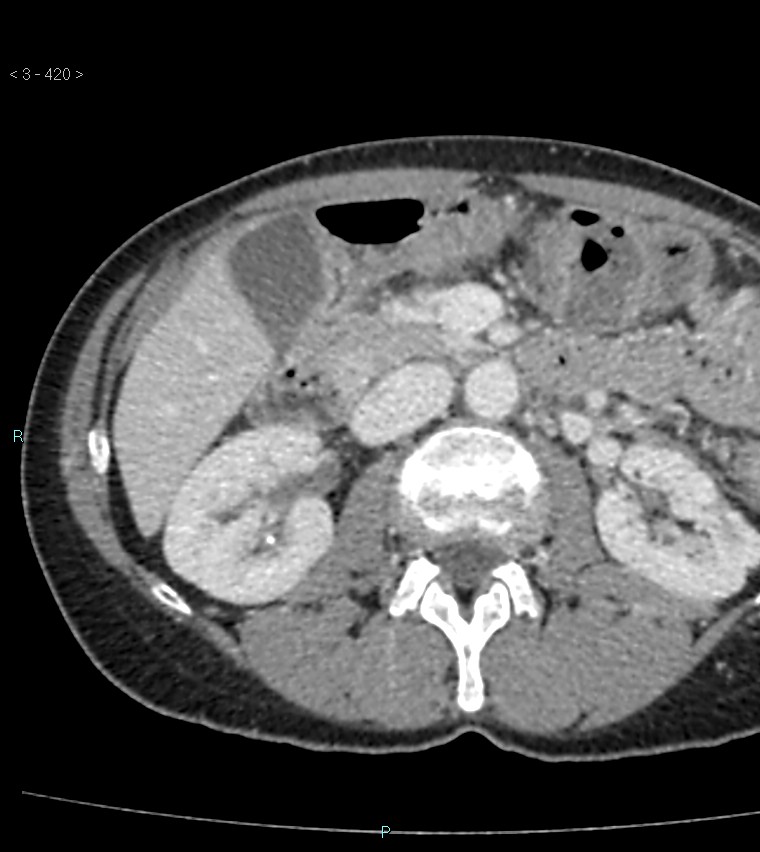 Ampulla of Vater metastasis (Radiopaedia 27820-28065 A 24).jpg