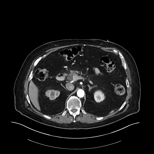 Ampullary adenocarcinoma (Radiopaedia 59373-66734 A 57).jpg
