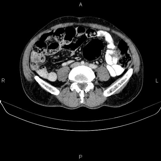 Ampullary adenocarcinoma (Radiopaedia 86093-102032 A 38).jpg