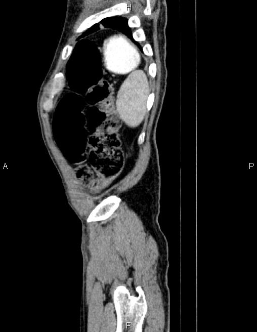 Ampullary adenocarcinoma (Radiopaedia 86093-102032 D 90).jpg