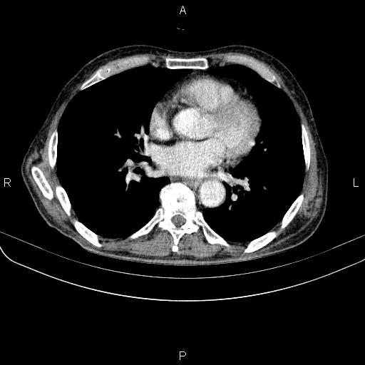 Ampullary adenocarcinoma (Radiopaedia 86093-102033 B 37).jpg
