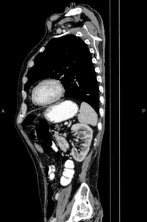 Ampullary adenocarcinoma (Radiopaedia 86093-102033 E 69).jpg