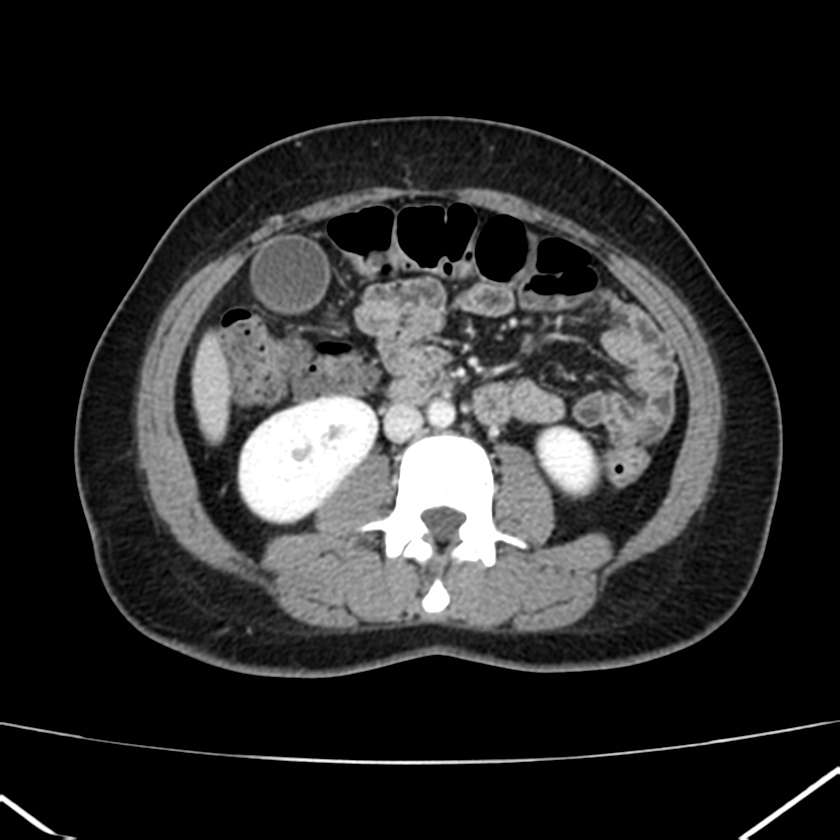 Ampullary tumor (Radiopaedia 22787-22816 C 34).jpg
