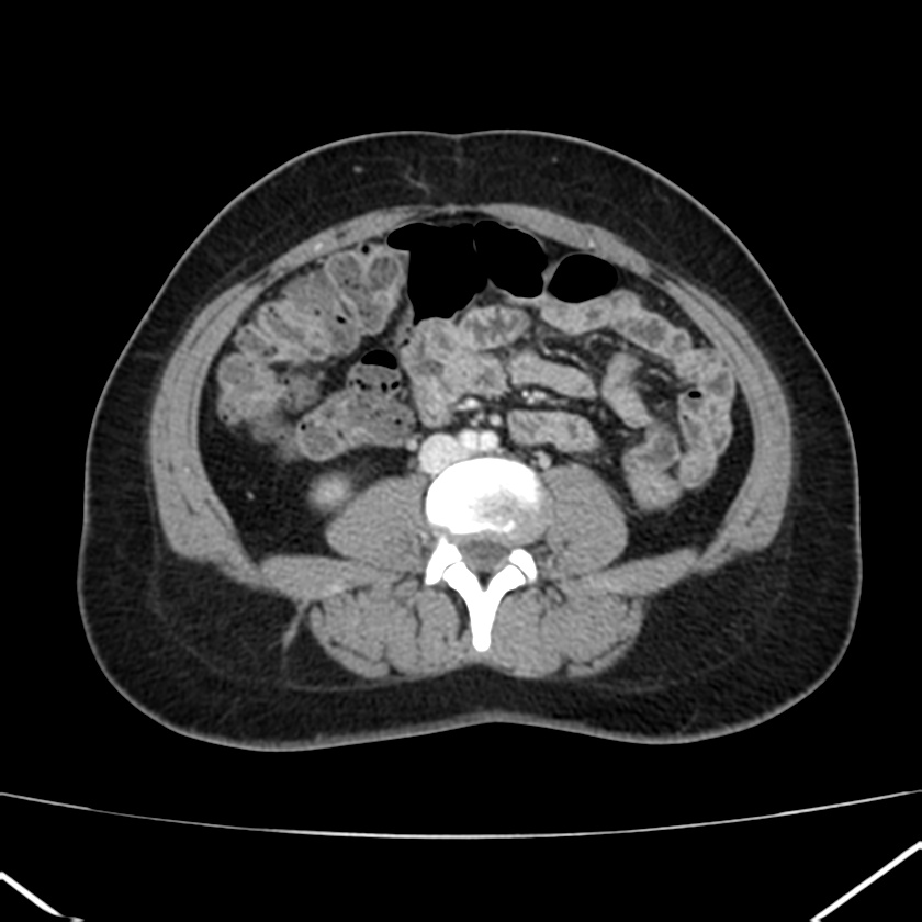 Ampullary tumor (Radiopaedia 22787-22816 C 38).jpg