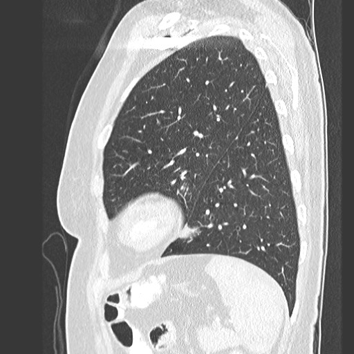 Amyloidosis - bronchial and diffuse nodular pulmonary involvement (Radiopaedia 60156-67745 Sagittal lung window 71).jpg