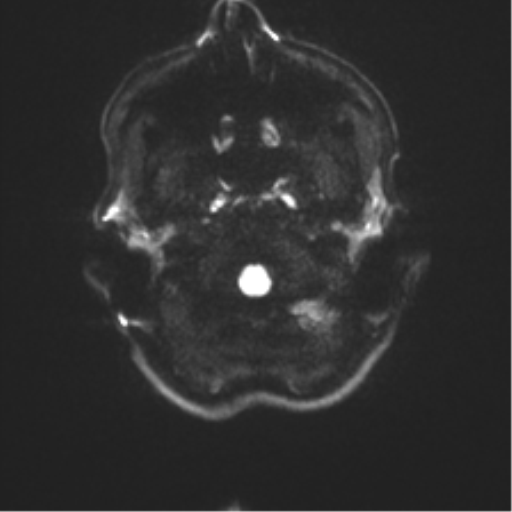 Anaplastic astrocytoma IDH mutant (Radiopaedia 50046-55341 Axial DWI 29).png