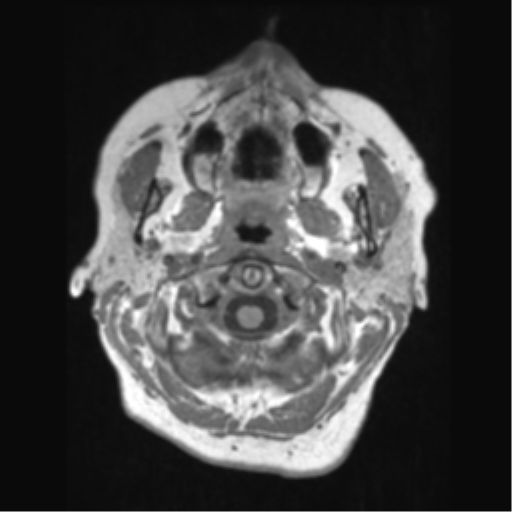 File:Anaplastic astrocytoma IDH wild-type (pseudoprogression) (Radiopaedia 42209-45276 Axial T1 12).png