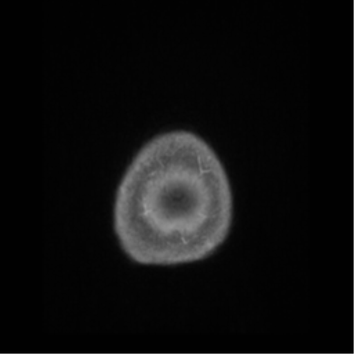 File:Anaplastic astrocytoma IDH wild-type (pseudoprogression) (Radiopaedia 42209-45276 Axial T1 C+ 149).png