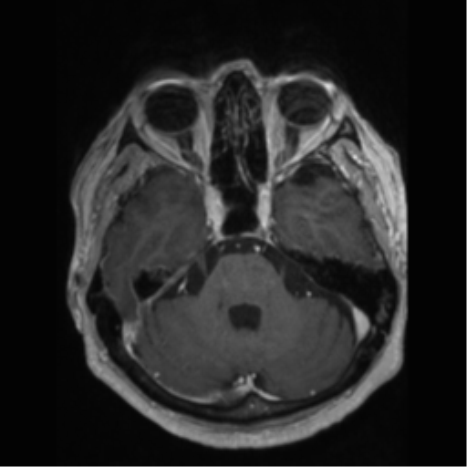 File:Anaplastic astrocytoma IDH wild-type (pseudoprogression) (Radiopaedia 42209-45277 Axial T1 C+ 34).png
