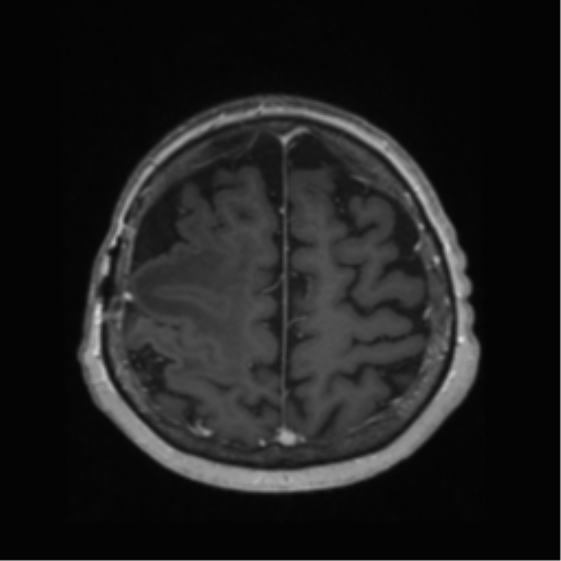 File:Anaplastic astrocytoma IDH wild-type (pseudoprogression) (Radiopaedia 42209-45278 Axial T1 C+ 120).png