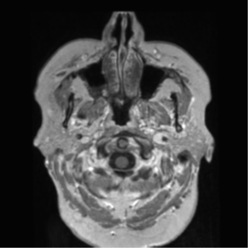 File:Anaplastic astrocytoma IDH wild-type (pseudoprogression) (Radiopaedia 42209-45278 Axial T1 C+ 18).png