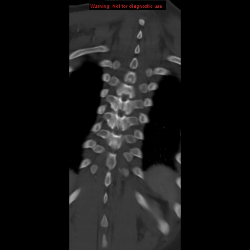 File:Aneurysmal bone cyst (Radiopaedia 9419-10102 Coronal bone window 19).jpg