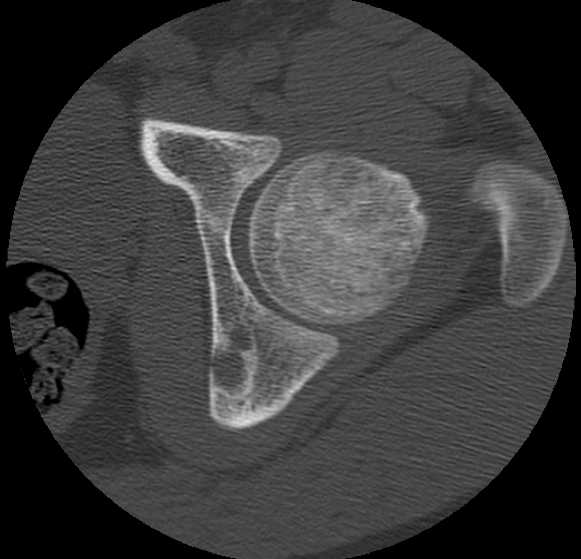Aneurysmal bone cyst of ischium (Radiopaedia 25957-26094 B 13).png