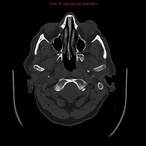 File:Aneurysmal subarachnoid hemorrhage (Radiopaedia 24740-24997 bone window 1).jpg